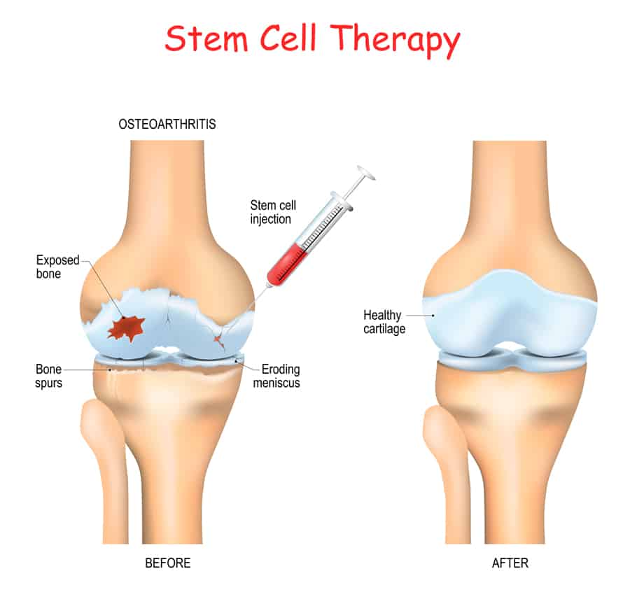 A medical professional injecting stem cells into a patient's bone as part of the stem cell therapy process.
